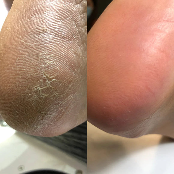 Keratolytic for feet Podology + 100ml NAILSOFTHEDAY - Foot care
