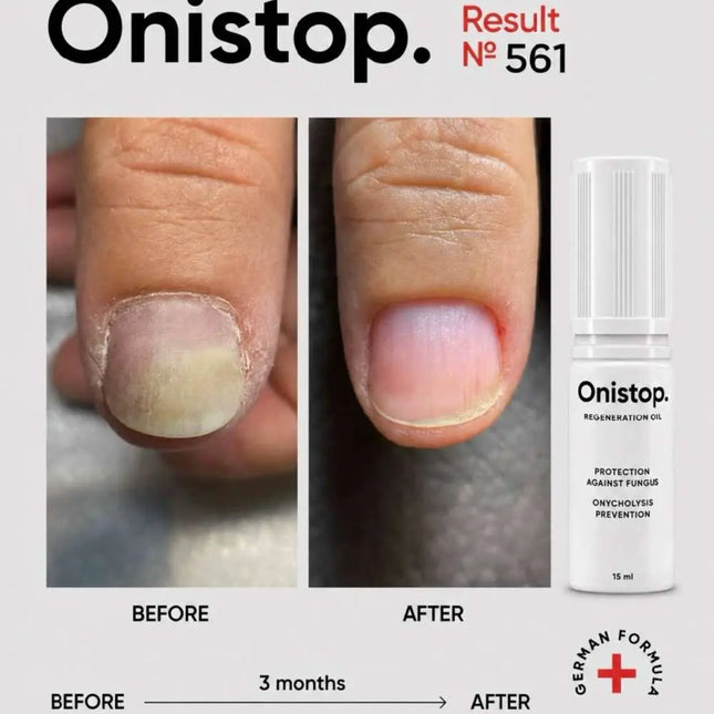 Ulei regenerant împotriva onicolizei - OniStop 15ml NAILSOFTHEDAY
