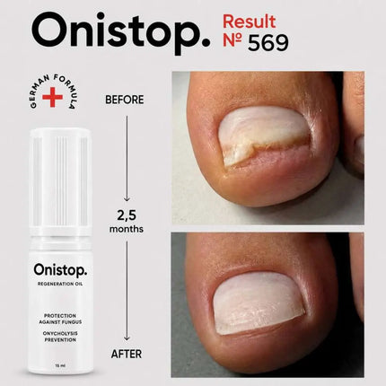 Регенерирующее масло против онихолиза - OniStop 15 мл NAILSOFTHEDAY